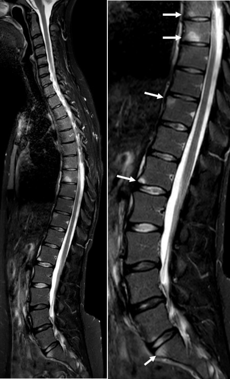 lesions on mri t spine